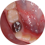 Stainless Steel Crown Dental Service Houston, TX