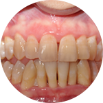 Scaling and Root Planing Dental Service Houston, TX