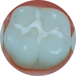 Sealants Dental Service Houston, TX