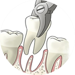 Extractions Dental Service Houston, TX
