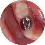 Fillings Dental Service Houston, TX