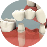 Crowns and Bridges Dental Service Houston, TX