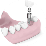 Dental Implants Dental Service Houston, TX