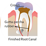 Root Canal Dental Service Houston, TX