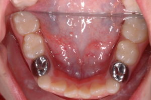 Pulpotomy Houston, TX