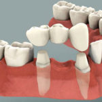 Dental Crowns Houston, TX