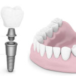 Dental Implants Houston, TX