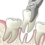 Teeth Extraction Houston, TX