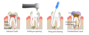 Root Canal Houston, TX
