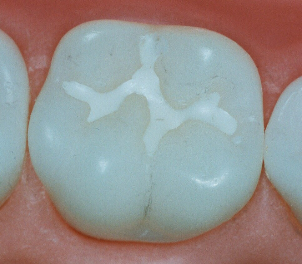 Sealants Dental Service Houston, TX